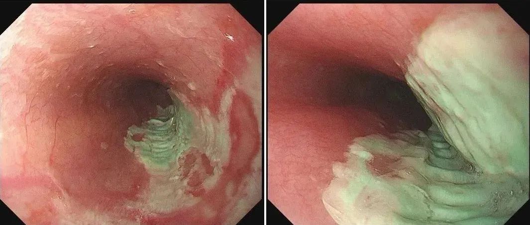 触目惊心!一男子食道被药片“割烂”,医生:这几个服药习惯害了太多人 触目惊心!一男子食道被药片“割烂”,医生:这几个服药习惯害了太多人