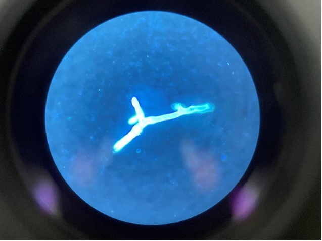 能“钻”入鼻腔，“啃噬”眼球脑子！医生紧急提醒→