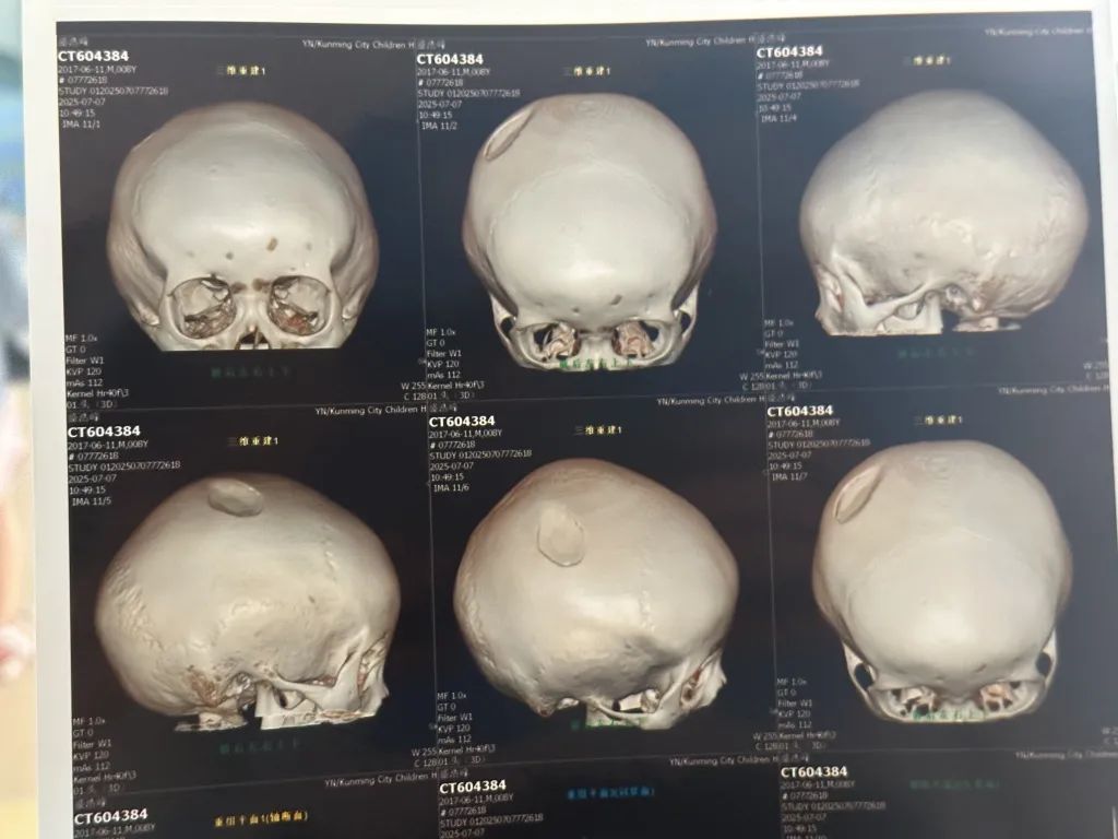 8岁小孩遭男子醉酒后用椅子砸头,“要做开颅手术” 8岁小孩遭男子醉酒后用椅子砸头,“要做开颅手术”