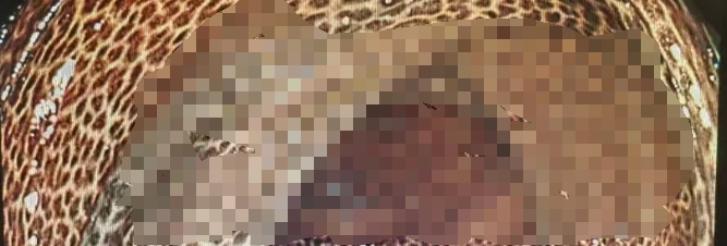 太吓人!男子整条肠道变黑,长满“豹纹”!只因长期喝这种东西...... 太吓人!男子整条肠道变黑,长满“豹纹”!只因长期喝这种东西......