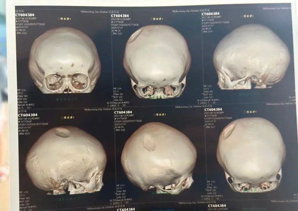 8岁小孩遭醉汉用椅子砸头,“要做开颅手术” 8岁小孩遭醉汉用椅子砸头,“要做开颅手术”