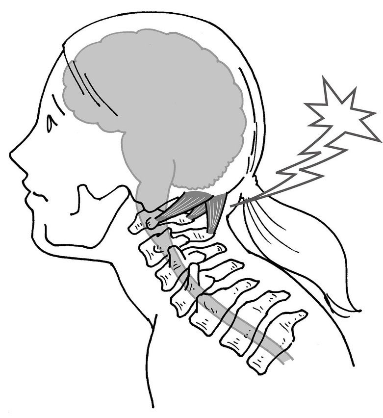 后脑勺下方疼，可能是这个原因！