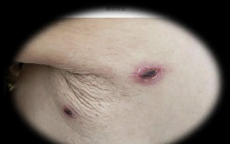 男子持续高烧被确诊！提醒：目前正是高发期，尽量减少在这些地方坐卧停留→