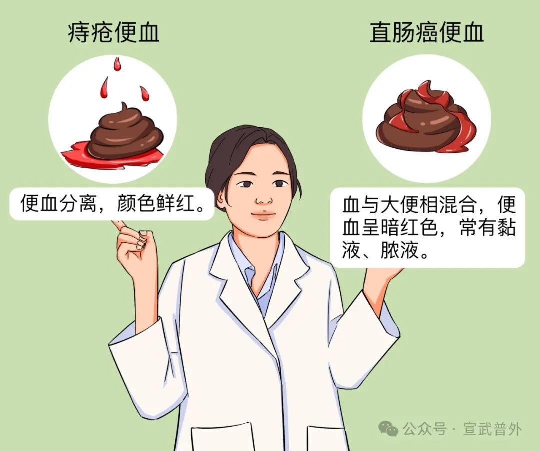 痔疮和直肠癌的鉴别大作战