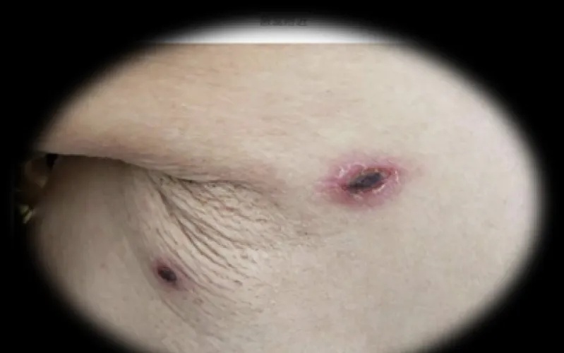 39.5℃！男子持续高烧被确诊，医生提醒：目前正是高发期