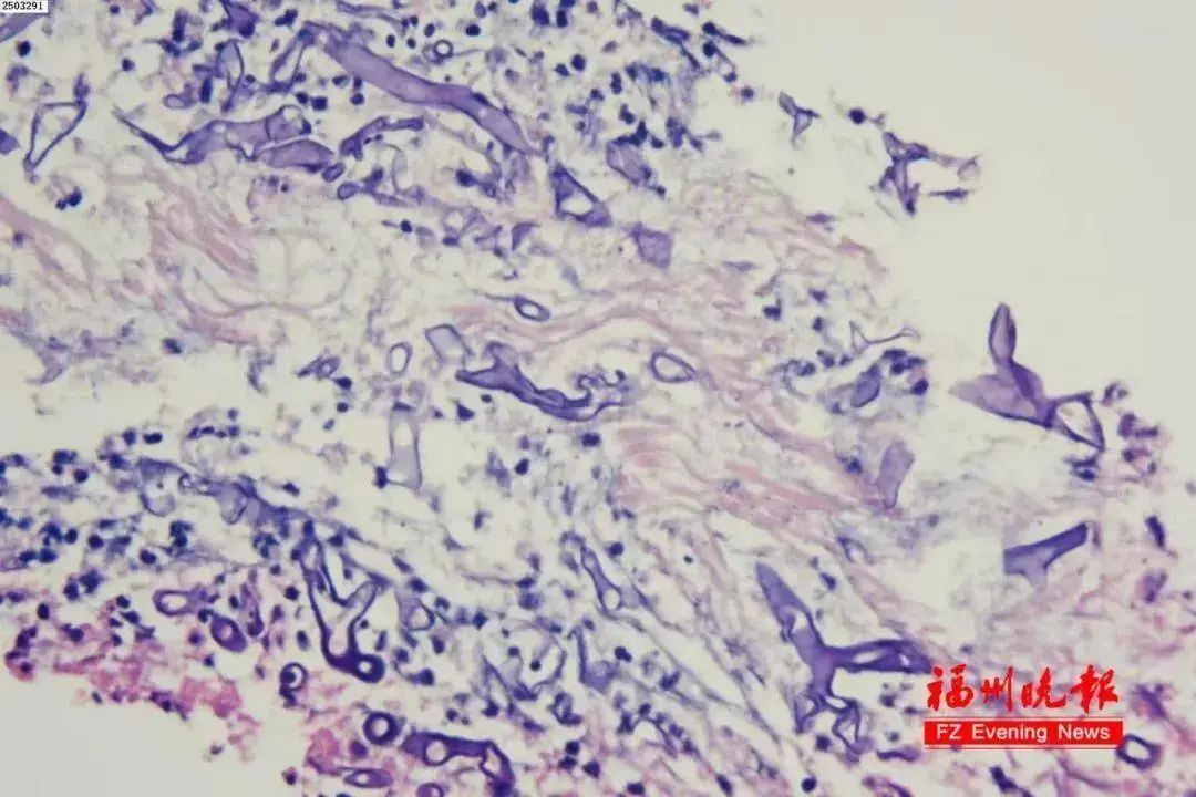 "长毛"咳血？这种真菌感染很危险！夏季高发→