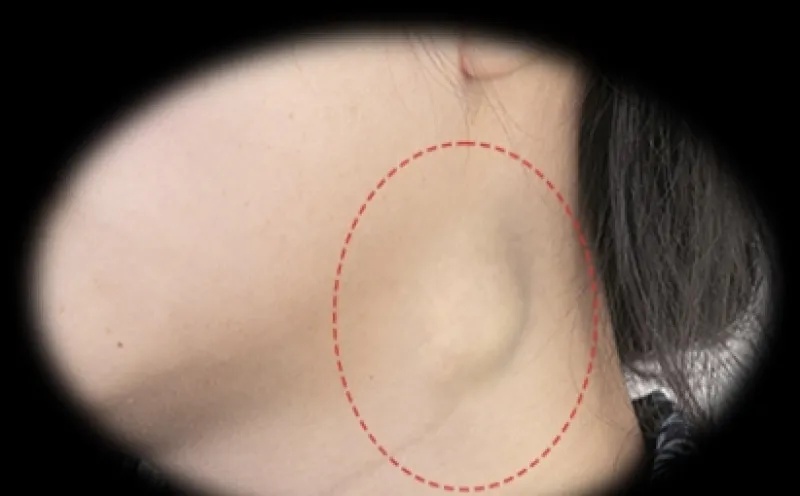 39.5℃！男子持续高烧被确诊，医生提醒：目前正是高发期