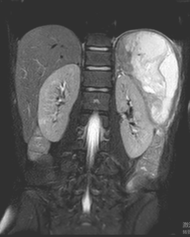 13岁少年被切除重要器官！脾脏脆弱“如豆腐”，撞击很要命