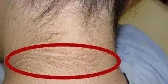 脖子黑黑的、总是洗不干净?可能是身体在“求救”! 脖子黑黑的、总是洗不干净?可能是身体在“求救”!