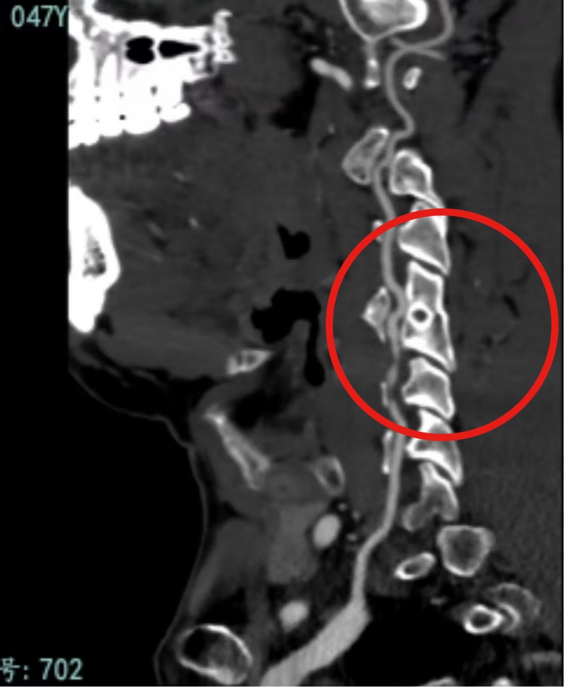 极危险!妻子帮按摩,男子险丧命……医生:这种放松千万小心 极危险!妻子帮按摩,男子险丧命……医生:这种放松千万小心