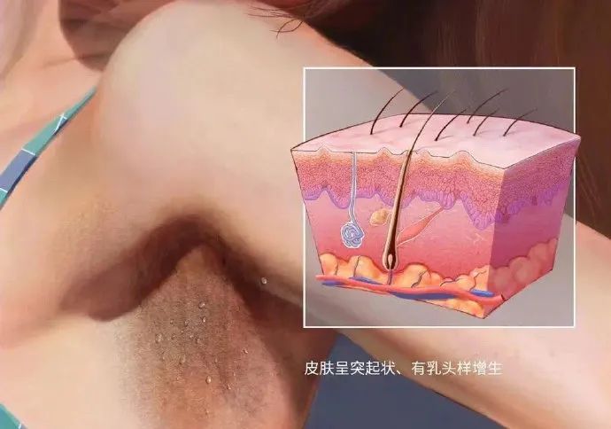 脖子黑黑的、总是洗不干净?可能是身体在“求救”! 脖子黑黑的、总是洗不干净?可能是身体在“求救”!