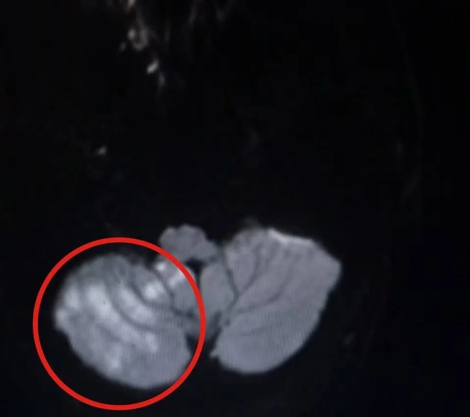 女子按摩却致丈夫小脑梗死！类似悲剧不止一起