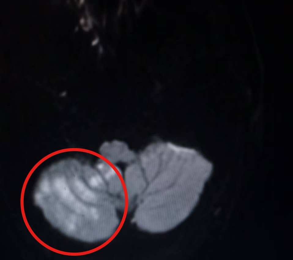 极危险!妻子帮按摩,男子险丧命……医生:这种放松千万小心 极危险!妻子帮按摩,男子险丧命……医生:这种放松千万小心