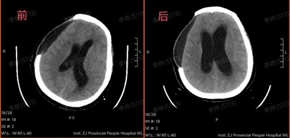 高温晒背2小时,67岁阿姨竟要开颅保命 高温晒背2小时,67岁阿姨竟要开颅保命