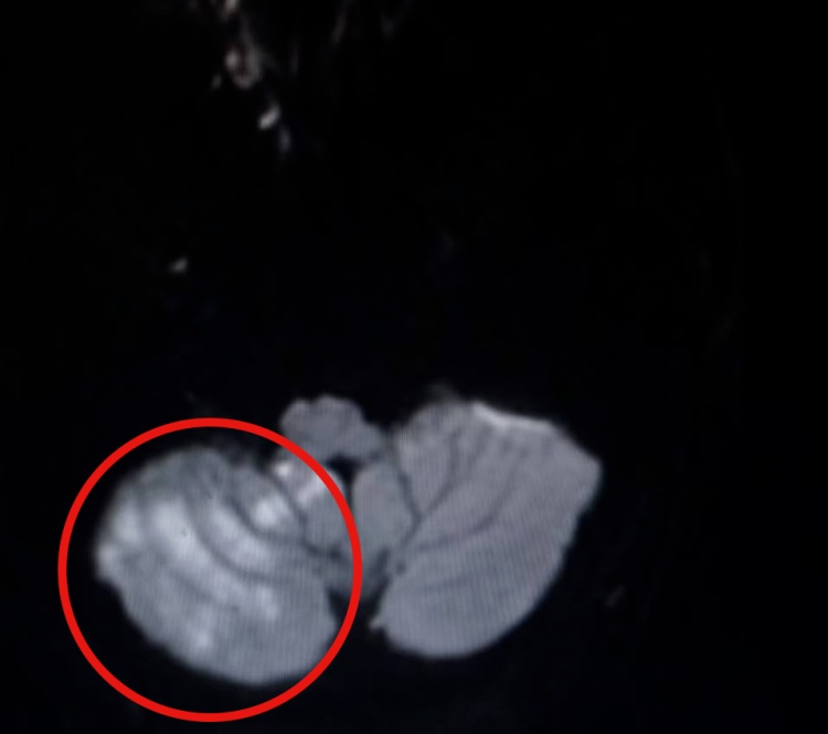 妻子好心之举,致47岁丈夫小脑梗死!类似悲剧不止一起,医生紧急提醒 妻子好心之举,致47岁丈夫小脑梗死!类似悲剧不止一起,医生紧急提醒