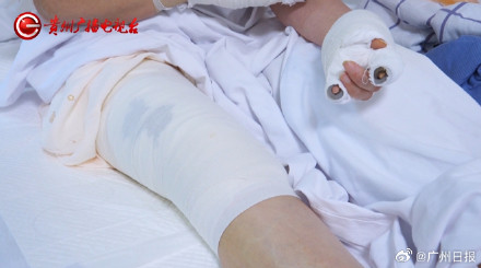 女子水中捡漂亮石头装裤兜里被烧伤,医生:“石头”初步判定是磷 女子水中捡漂亮石头装裤兜里被烧伤,医生:“石头”初步判定是磷