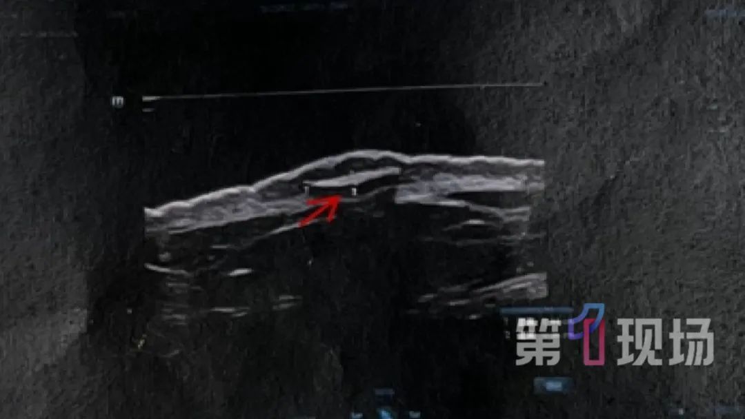 皮肤上的“蚊子包”9年不见好？一查竟是……这些“入侵者”要注意！