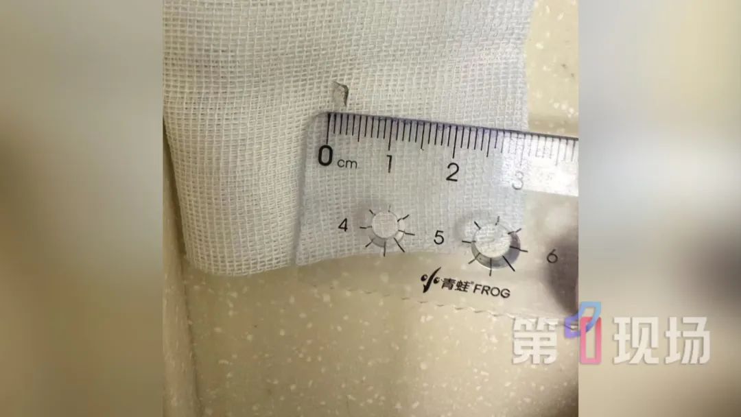 皮肤上的“蚊子包”9年不见好？一查竟是……这些“入侵者”要注意！