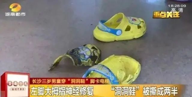 女子常穿洞洞鞋致足底钙化行走困难！医生紧急提醒：选鞋牢记这几点