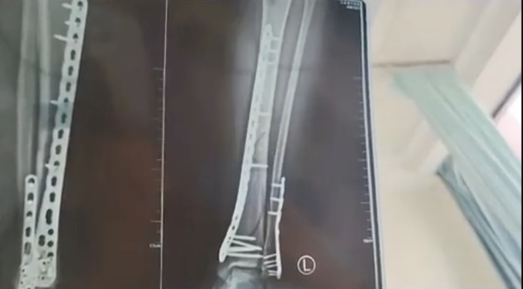 女子常穿洞洞鞋致足底钙化行走困难！医生紧急提醒：选鞋牢记这几点