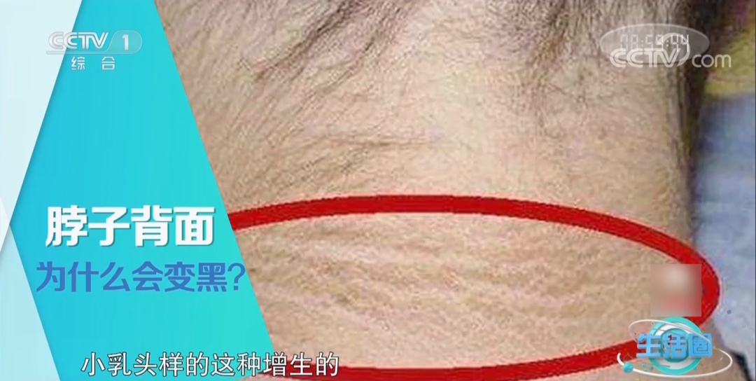 脖子发黑“洗不干净”？可能不是脏，是病！有这5种变化赶紧自查