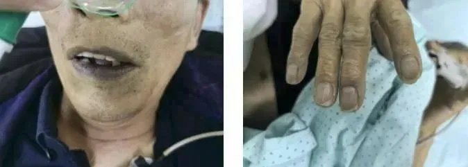 一碗下肚，中毒变“紫”了！这道菜很多人爱吃……