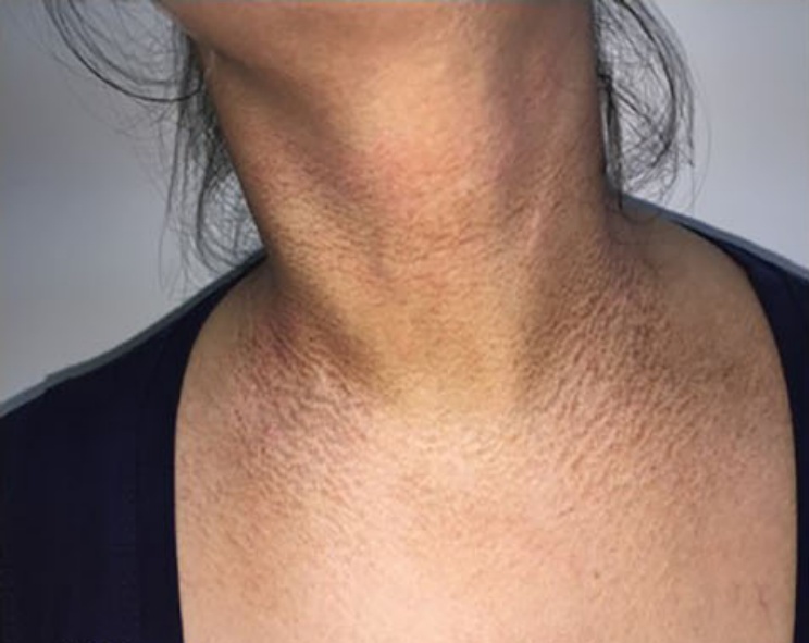 脖子总是黑黑的洗不干净？别大意，这可能是身体在“求救”！