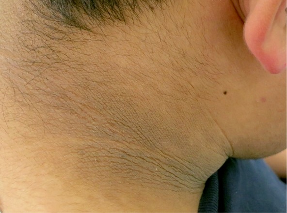 脖子总是黑黑的洗不干净？别大意，这可能是身体在“求救”！