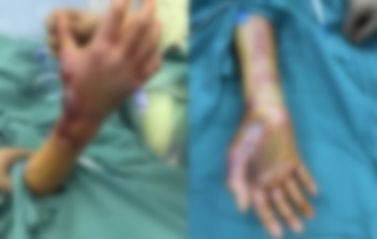 戴手套!戴手套!戴手套!死亡率近100%!小心这种“食人肉菌”… 戴手套!戴手套!戴手套!死亡率近100%!小心这种“食人肉菌”…