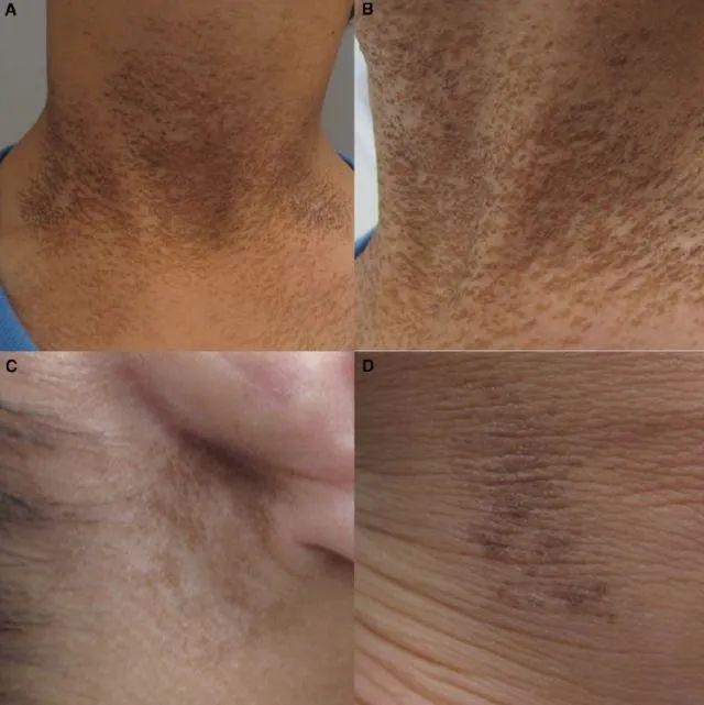 脖子总是黑黑的洗不干净？别大意，这可能是身体在“求救”！