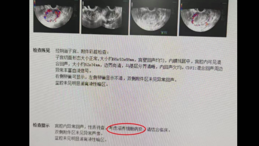 50岁女子意外怀孕竟诱发罕见癌症！医生提醒：这种癌非常少见