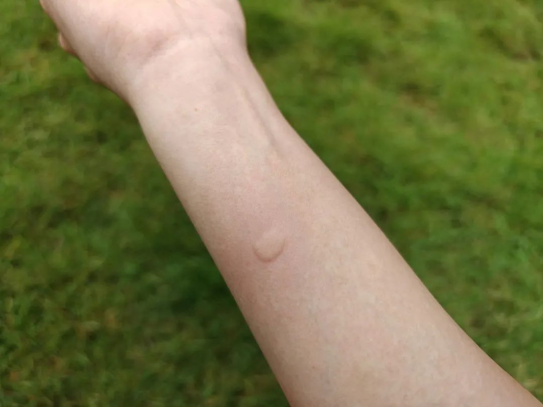 广东已有478人确诊!小心这种“花蚊子” 广东已有478人确诊!小心这种“花蚊子”