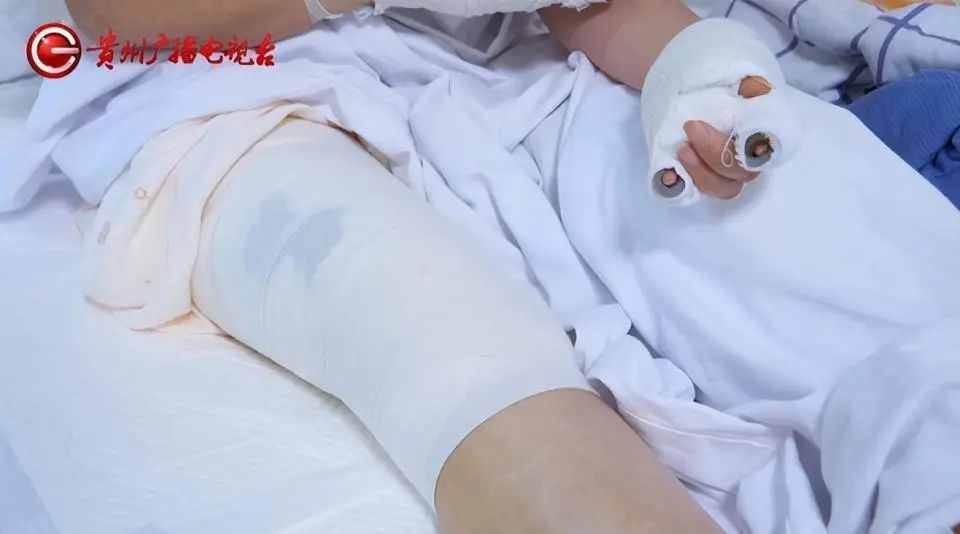 远离！瞬间炸裂极其危险，女子"一路燃烧到医院"