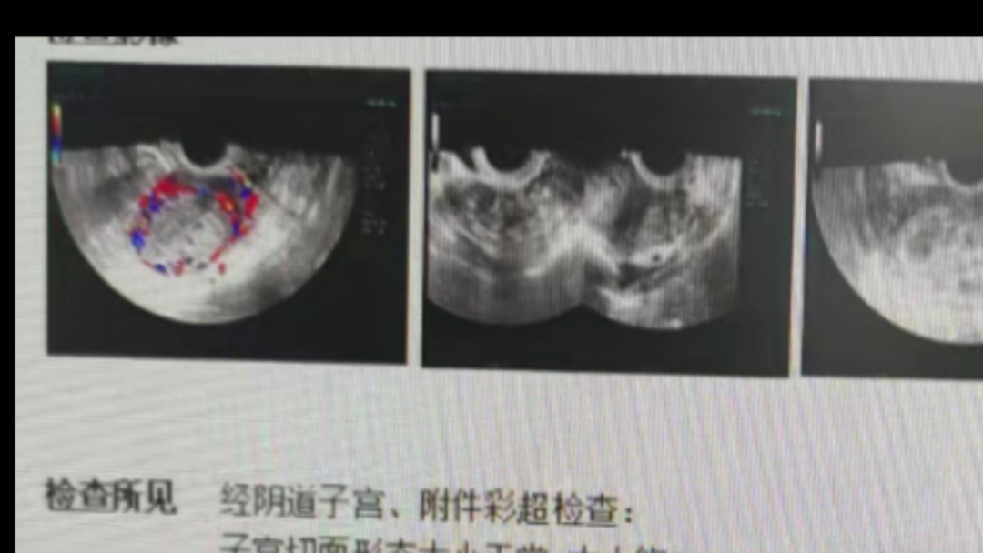 50岁女子意外怀孕竟诱发罕见癌症！医生提醒：这种癌非常少见