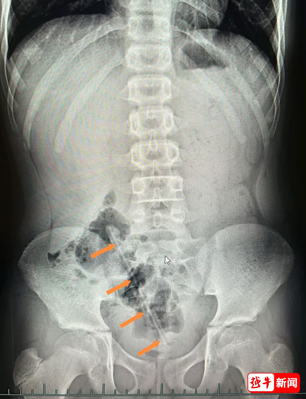 好奇害死猫！医生吓一跳！浙江一12岁男孩体内竟塞进了17cm长的...