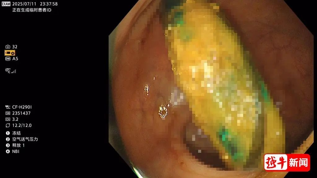 好奇害死猫！医生吓一跳！浙江一12岁男孩体内竟塞进了17cm长的...