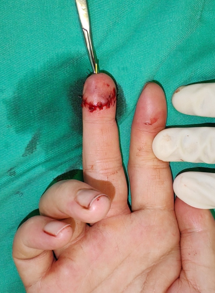 22岁女子被狗咬断手指！医生提醒：高温天需防宠物伤人