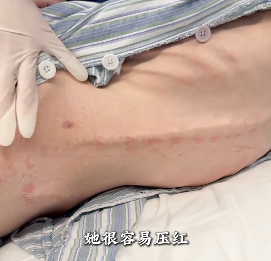39岁80斤女子疯狂减肥到50斤！每天猛吞200粒“小粉丸”，送医时已皮包骨