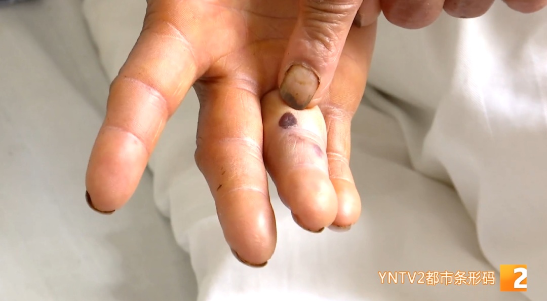 近期高发！昆明有医院已收治上百例患者！医生紧急提醒→