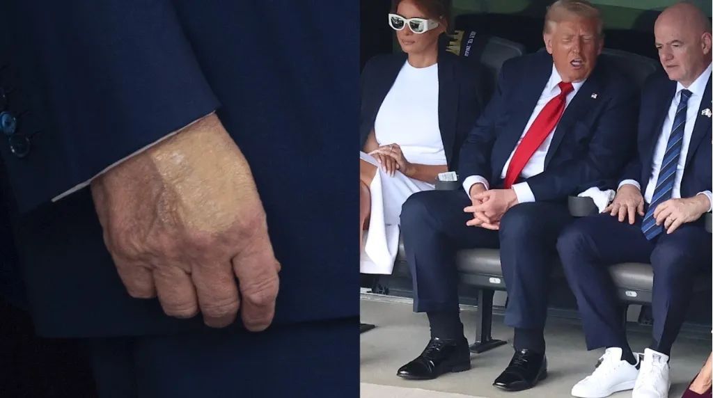 特朗普被确诊患静脉疾病 白宫说→