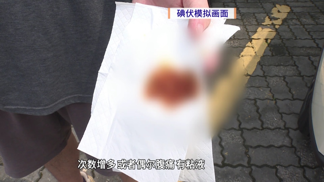 少见！广东一男子肠里有400多块息肉，有的已癌变！医生：出现这些症状要警惕