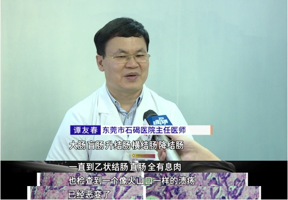 少见！广东一男子肠里有400多块息肉，有的已癌变！医生：出现这些症状要警惕