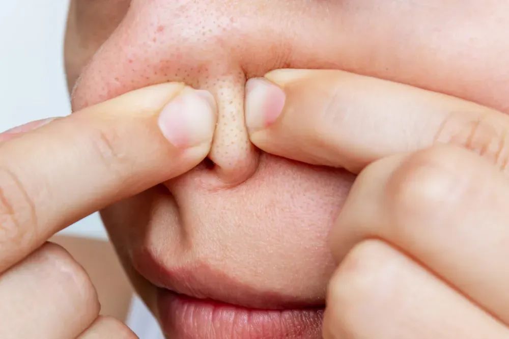 真的想问：下巴凸起的小颗粒，到底是什么呀？