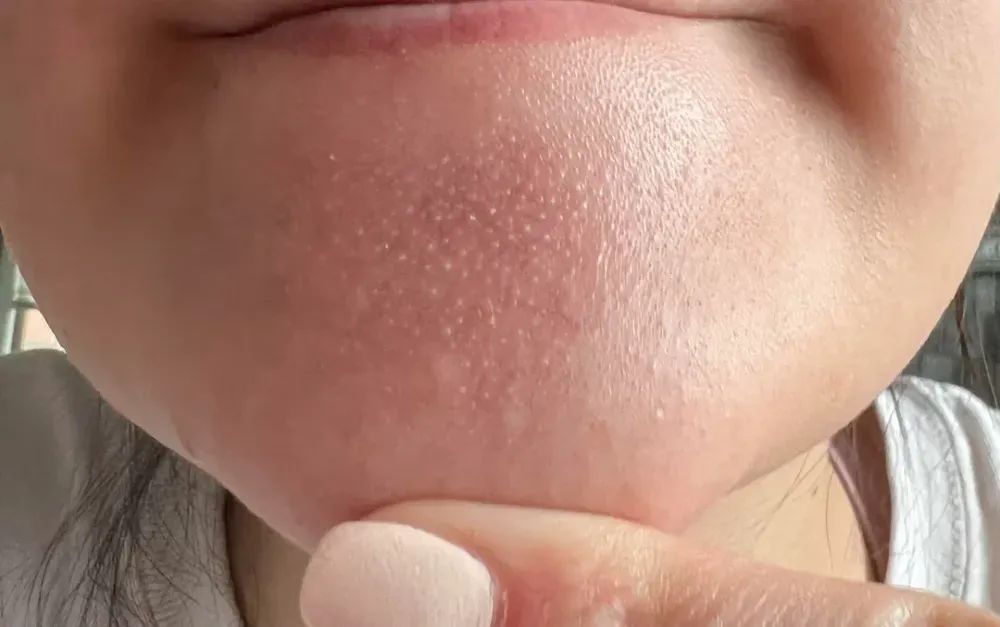 真的想问：下巴凸起的小颗粒，到底是什么呀？