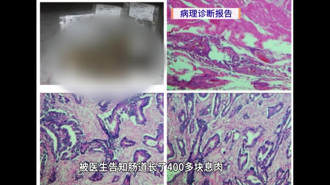 少见！广东一男子肠里有400多块息肉，有的已癌变！医生：出现这些症状要警惕