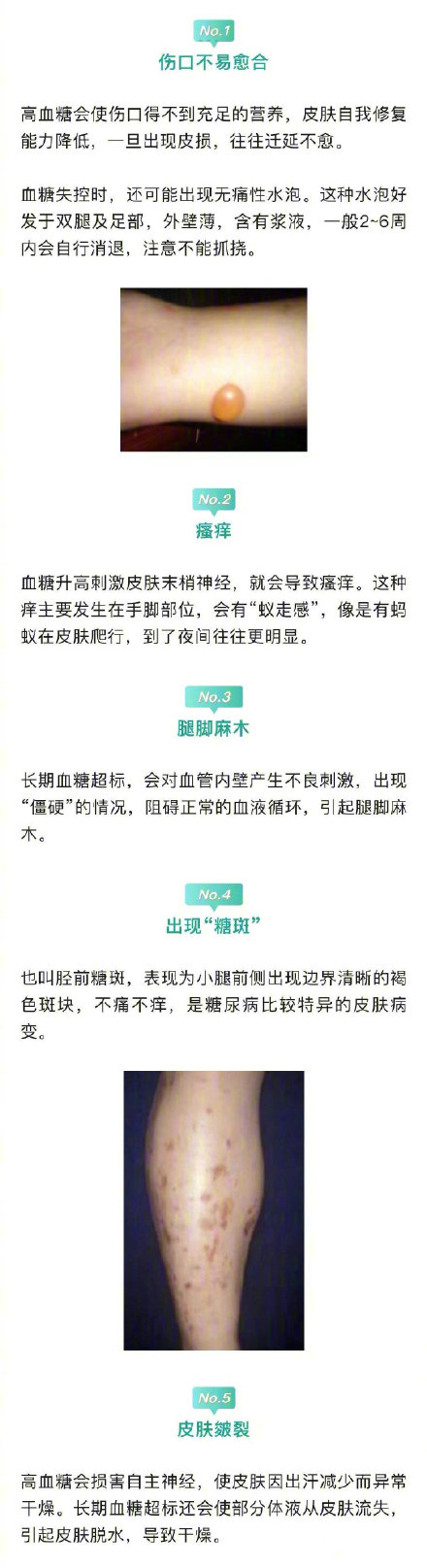医生说下肢是人体自带的血糖仪