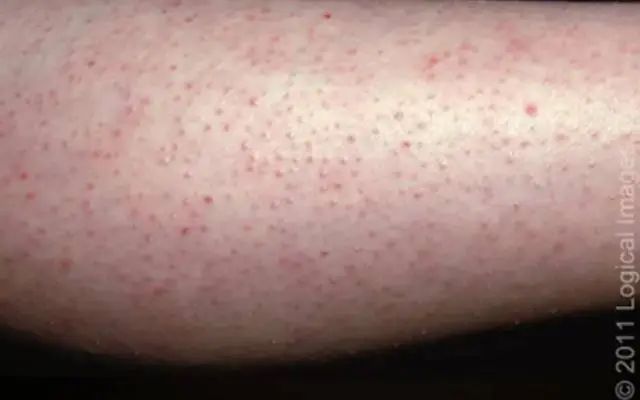 身上的这些小颗粒真不是痘痘,别抠!也别随便用药! 身上的这些小颗粒真不是痘痘,别抠!也别随便用药!