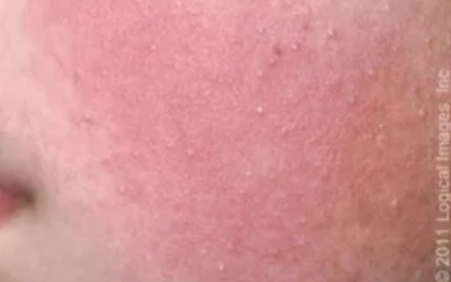 身上的这些小颗粒真不是痘痘,别抠!也别随便用药! 身上的这些小颗粒真不是痘痘,别抠!也别随便用药!