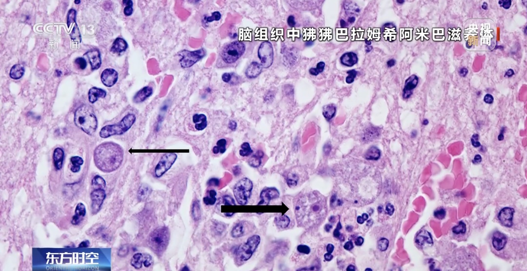 致死率高达98%!昆明医生提醒…… 致死率高达98%!昆明医生提醒……