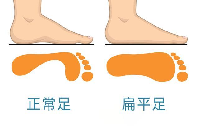 逐渐消失的足弓,可能正在伤害你的全身!一个方法拯救你→ 逐渐消失的足弓,可能正在伤害你的全身!一个方法拯救你→